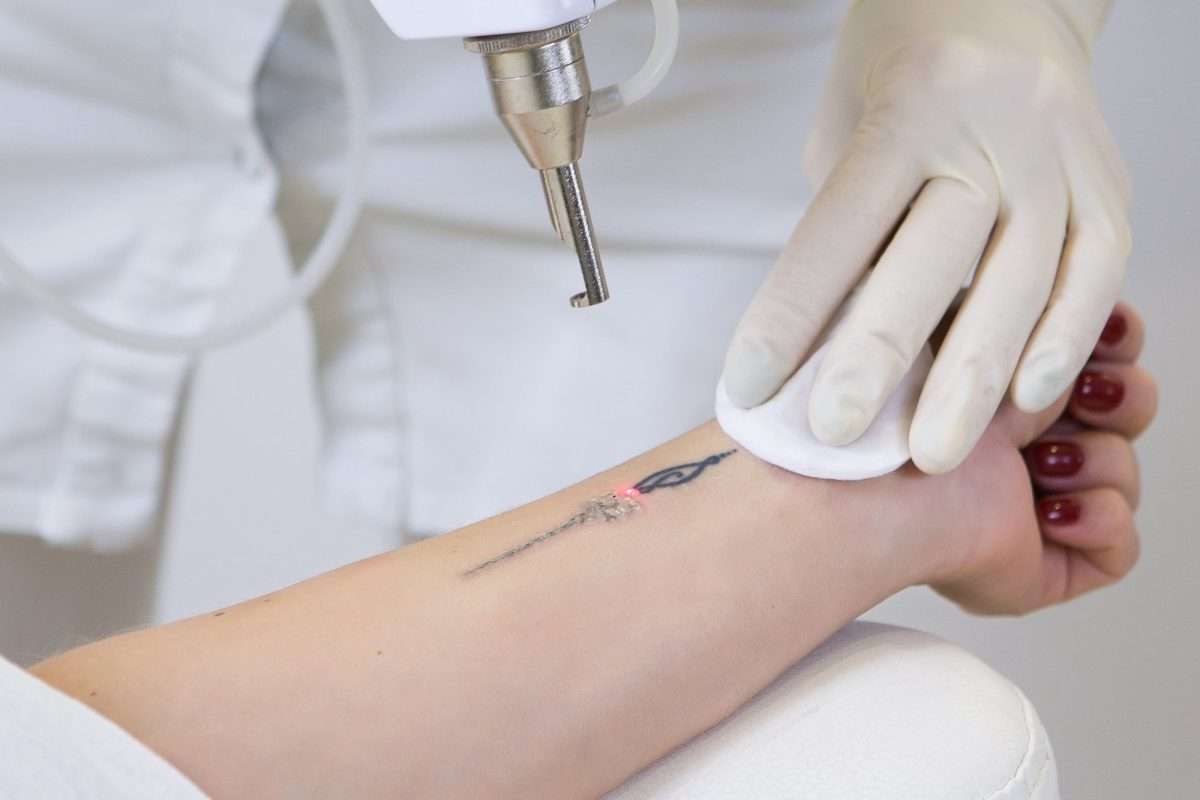 Can you tattoo over a laser removed tattoo?