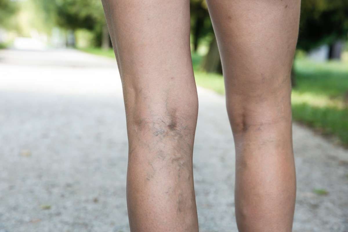 Can You Tattoo Over Varicose Veins?