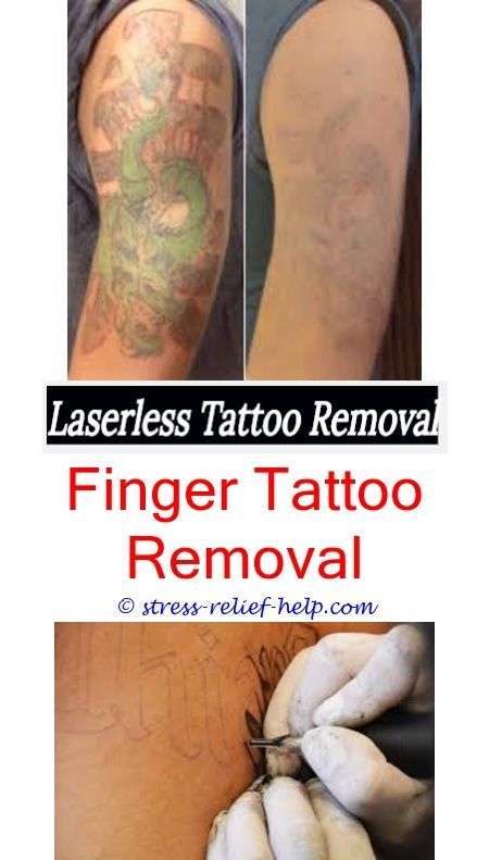 cheap tattoo removal tattoo removal wilmington nc
