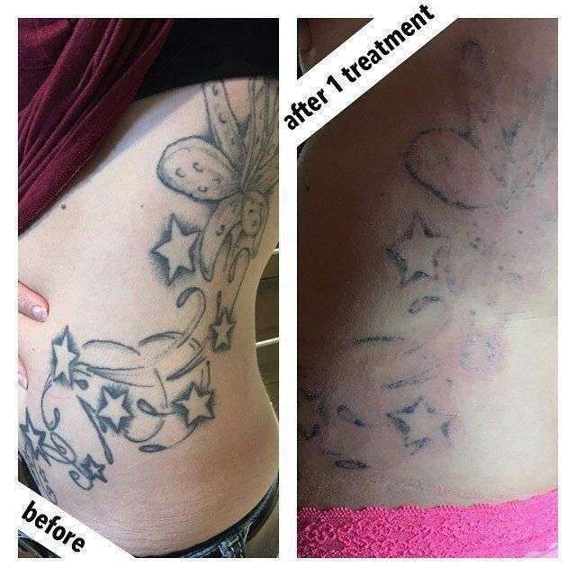Check out these results after just 1 Tattoo Removal session by Lynde ...
