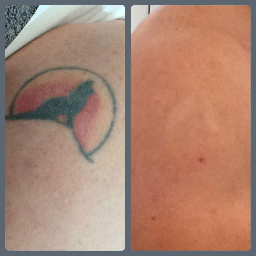 Colour Tattoo Removal Before And After : Laser Tattoo Removal London ...