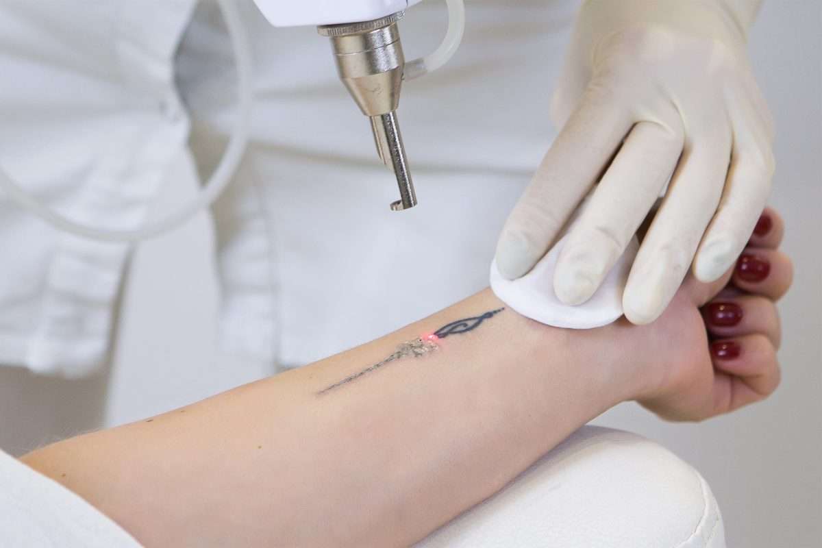 Cosmetic Tattoo Removal, Semi