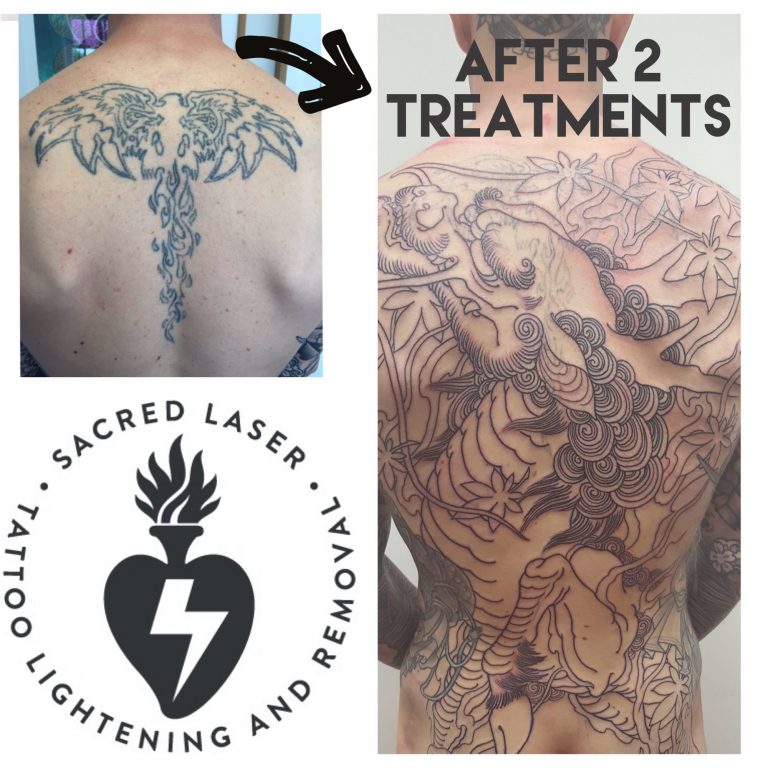 Cover up your old Tattoo by clearing the way with Tattoo Removal ...