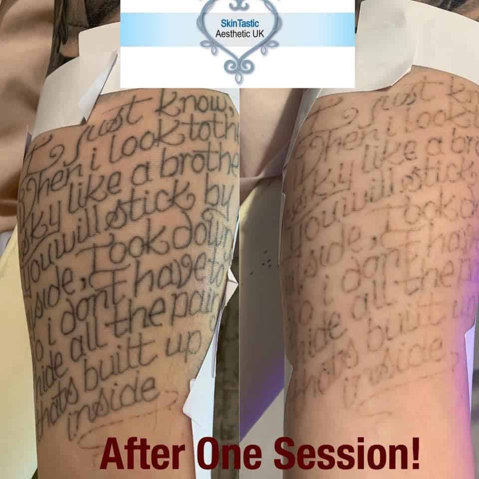 CPD Laser Tattoo Removal Training