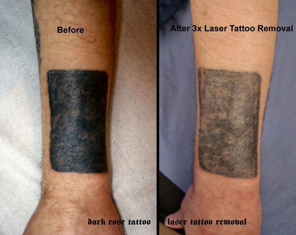 dark rose tattoo laser tattoo removal piece no56