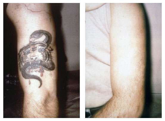 Dermatology Tattoo Removal / Tattoo Removal