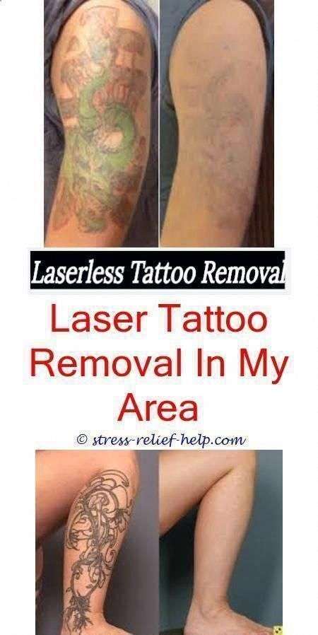 Do Laser Tattoo Removal Leave Scars