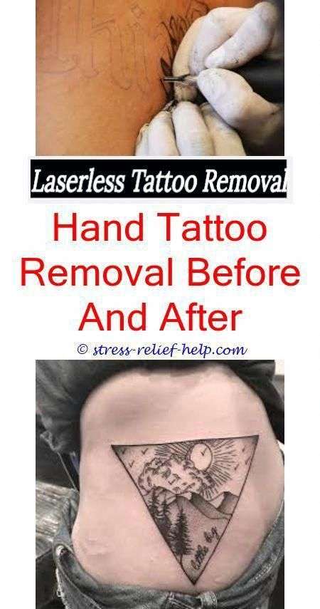 Does cigna insurance cover tattoo removal.Does laser ...