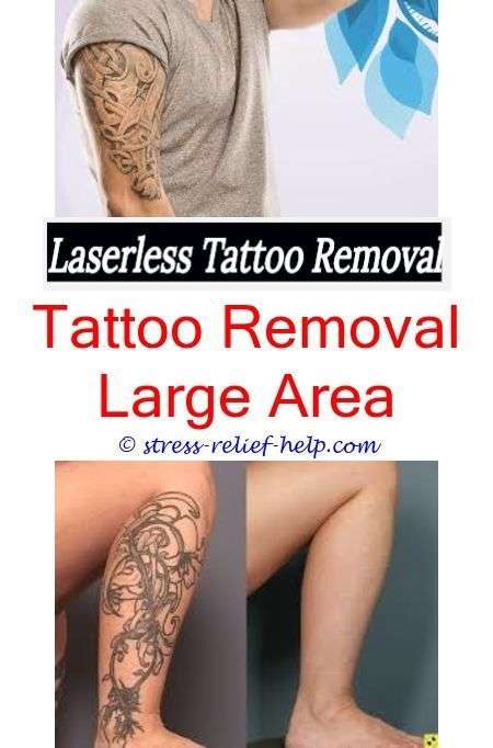 Does Laser Tattoo Removal Completely Remove