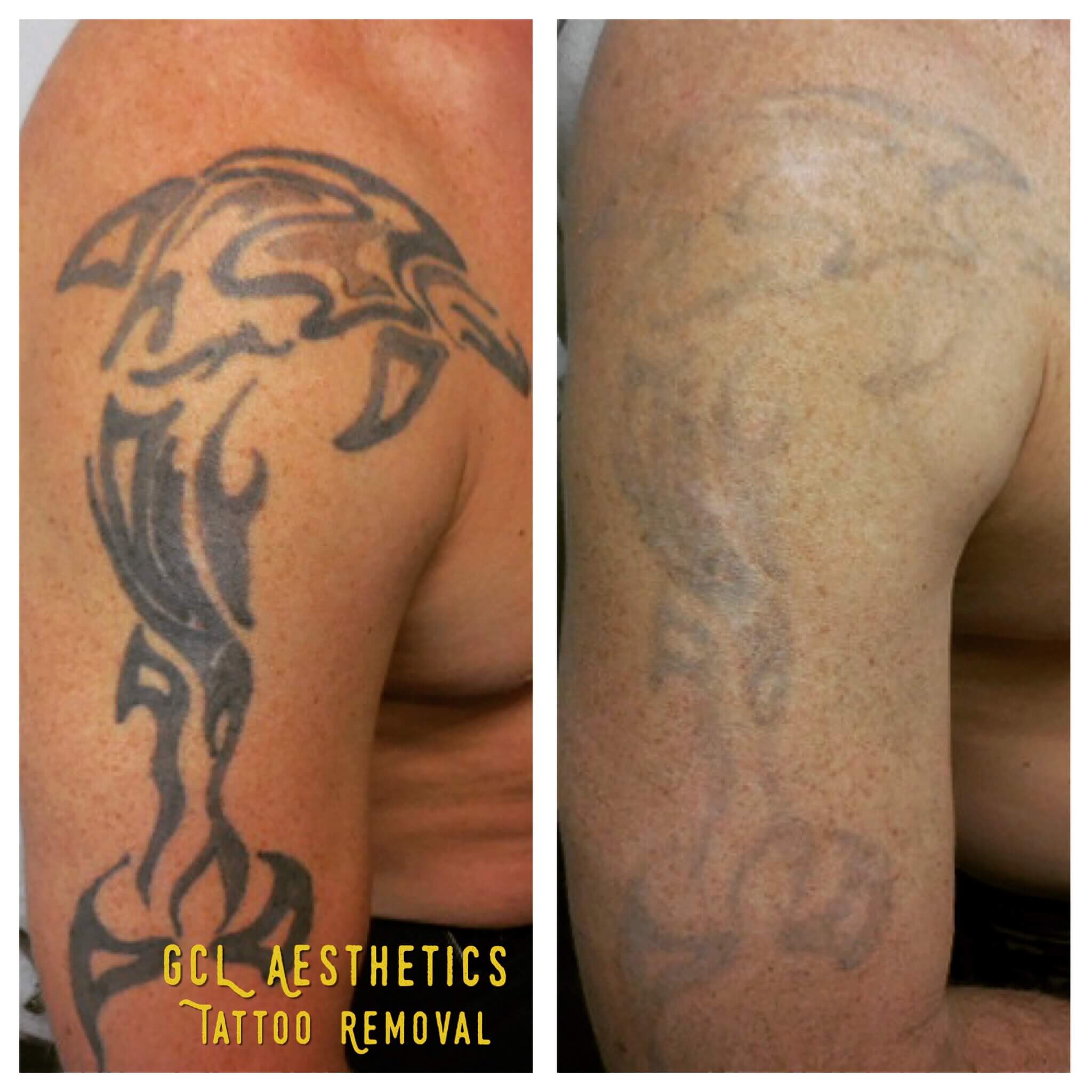 Does Laser Tattoo Removal Leave Scars