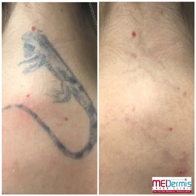 Does Laser Tattoo Removal Leave Scars