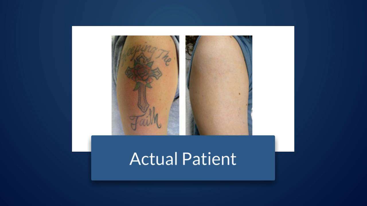 Does Laser Tattoo Removal Really Work West Palm Beach FL ...
