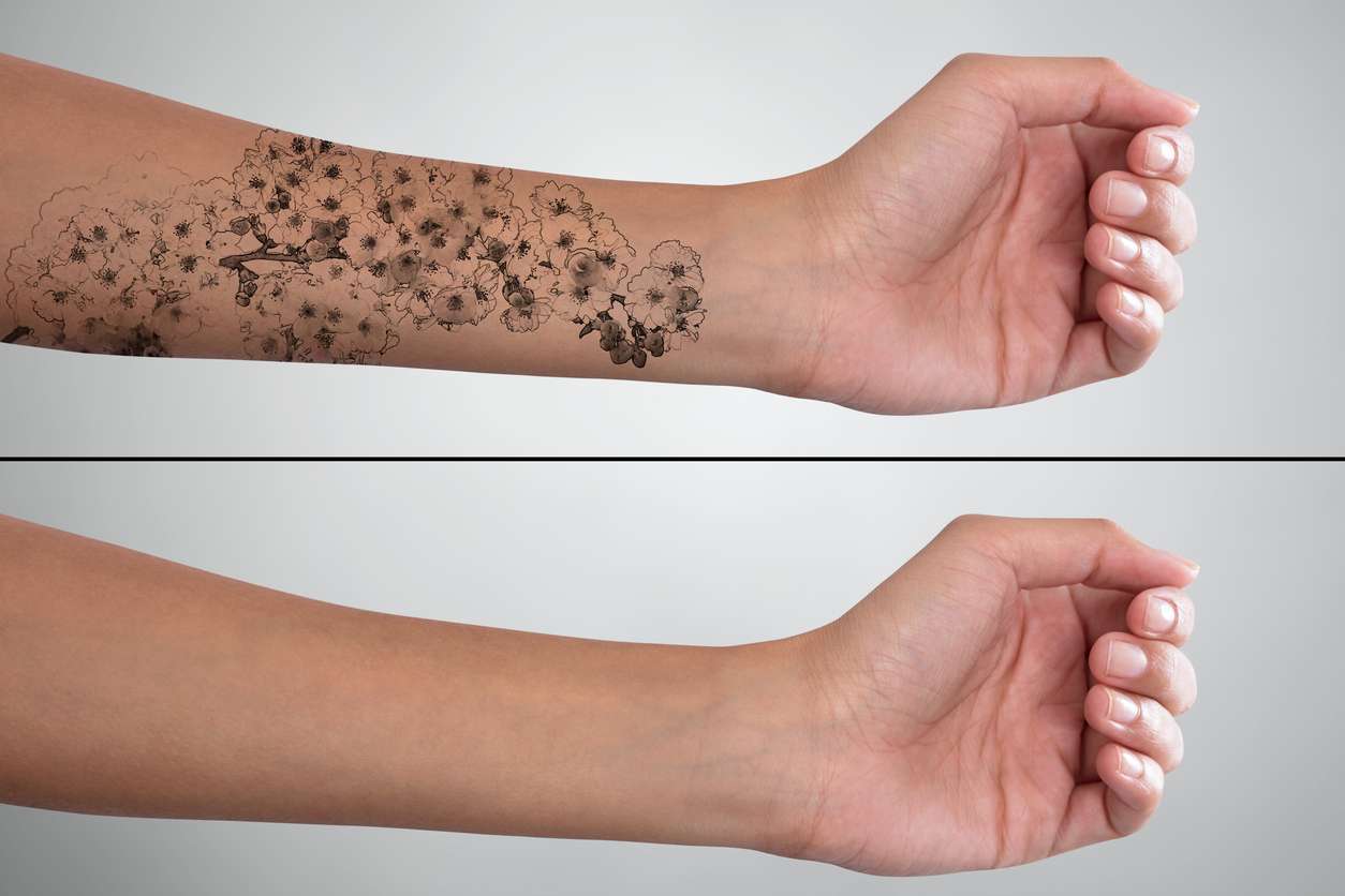 Does Tattoo Removal Hurt?
