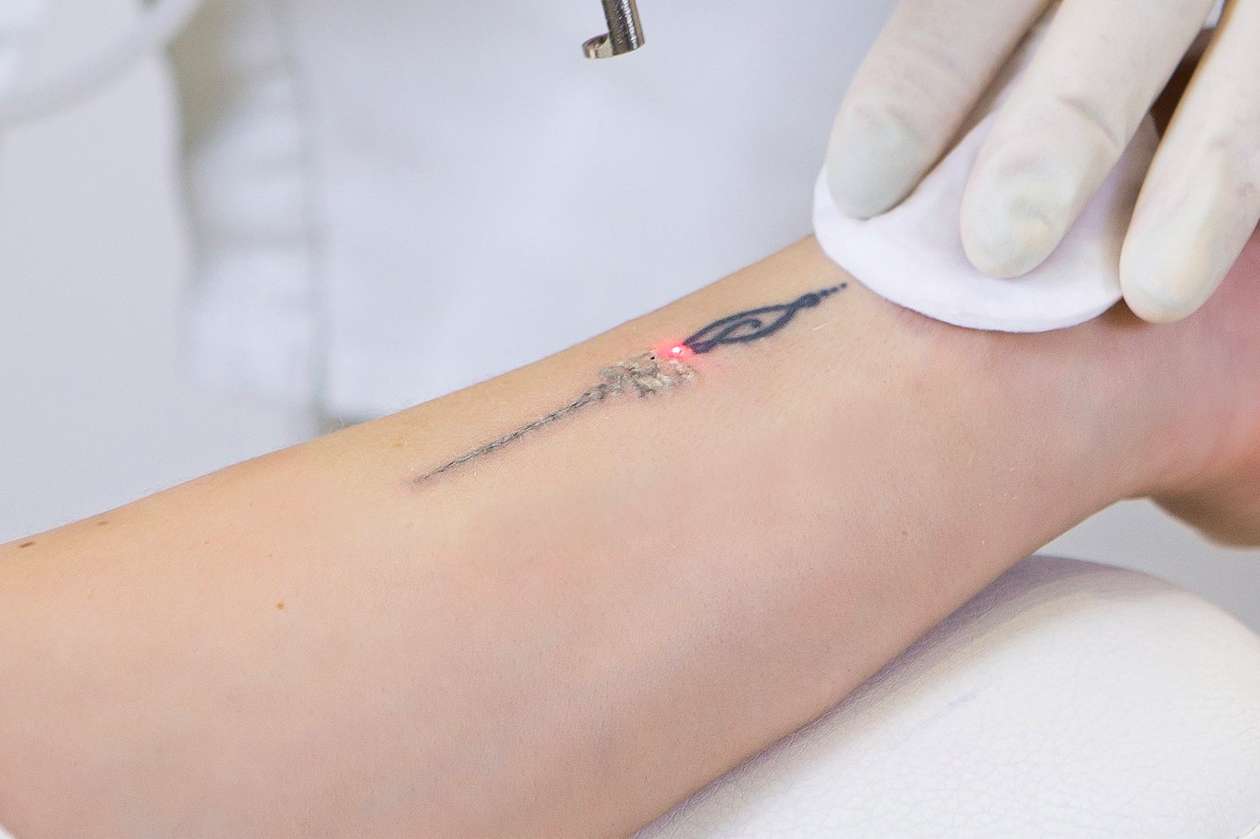 Effective Laser Tattoo Removal at Hilton Skin Clinic in ...