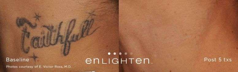 Enlighten Tattoo Removal Reviews
