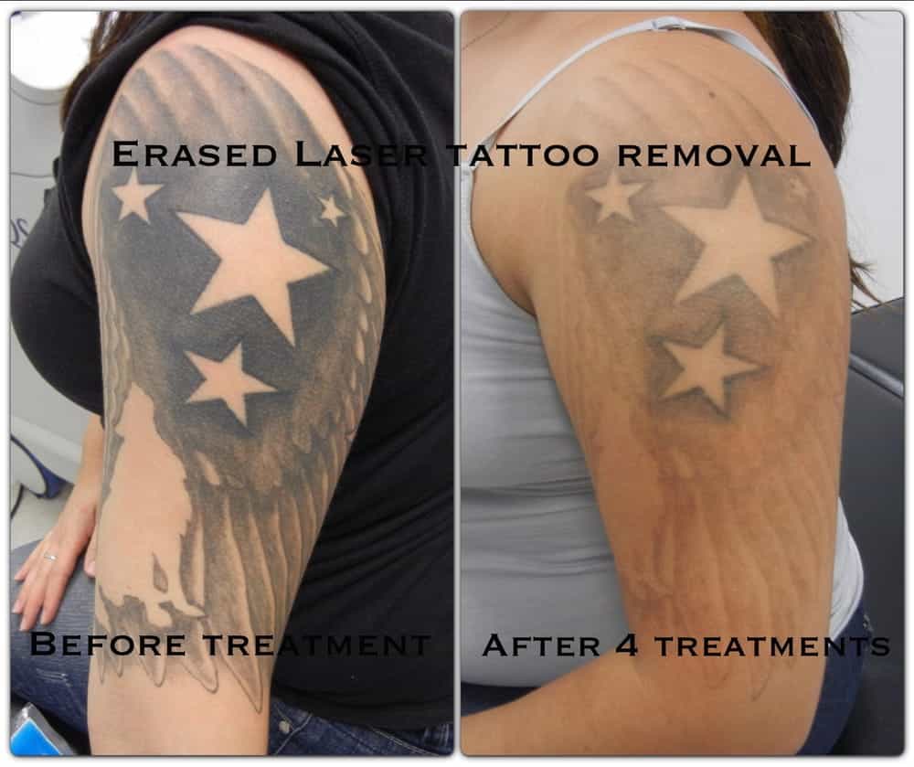 Erased Laser Tattoo Removal