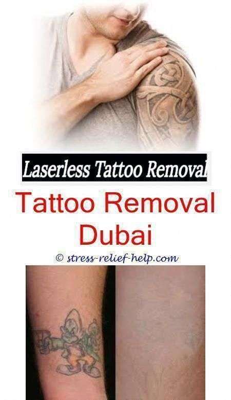excision tattoo removal who removes tattoos