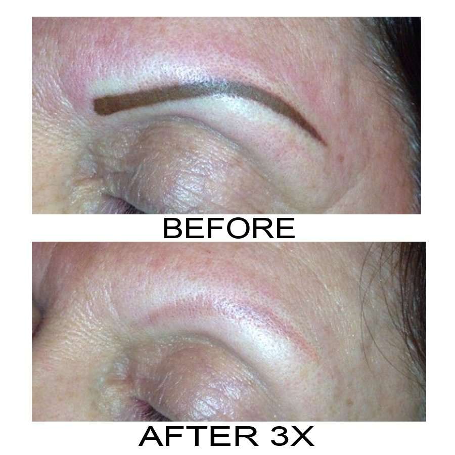 Eyebrow tattoo removal in preparation for Microblading
