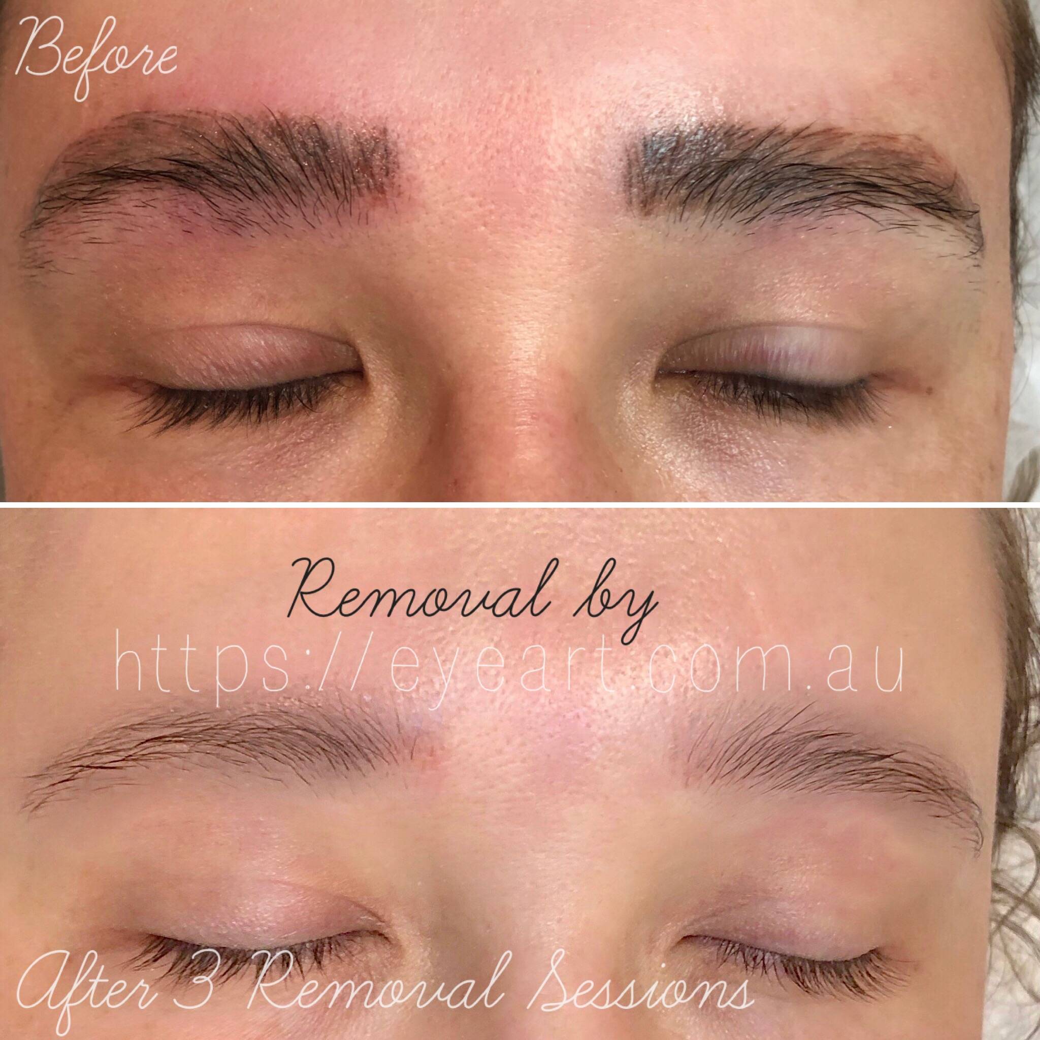 Eyebrow Tattoo Removal Melbourne, Victoria