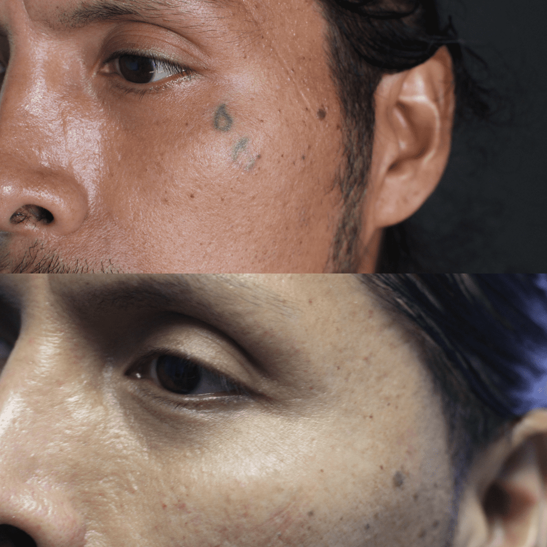 Face Tattoo Removal Services