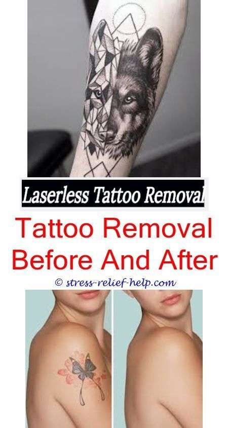 fast tattoo removal how much to remove a large tattoo
