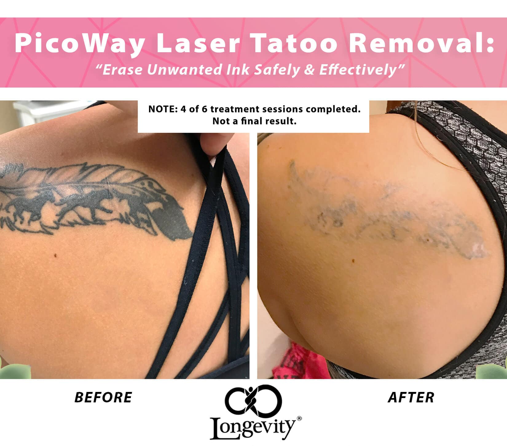 Fastest Way To Remove A Tattoo : How Laser Tattoo Removal Works Smarter ...