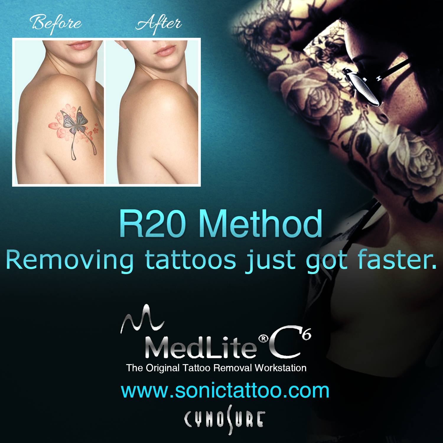 Fastest Way To Remove A Tattoo : How Laser Tattoo Removal ...