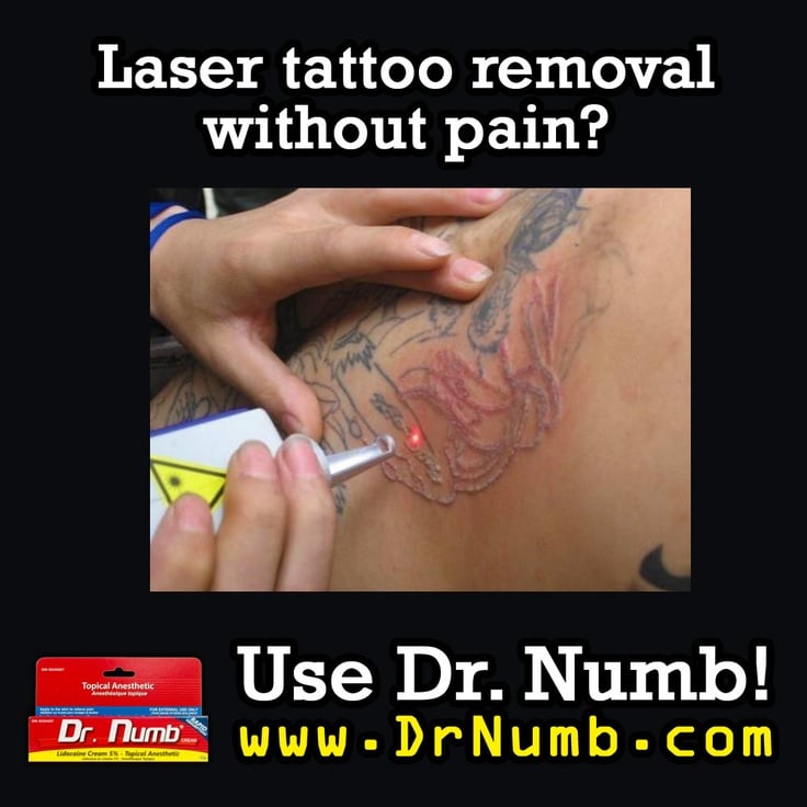 For painless laser tattoo removal, use Dr. Numb! The numbing cream ...