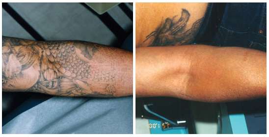 Free Tattoo Removal San Diego : Does Tattoo Removal Really ...