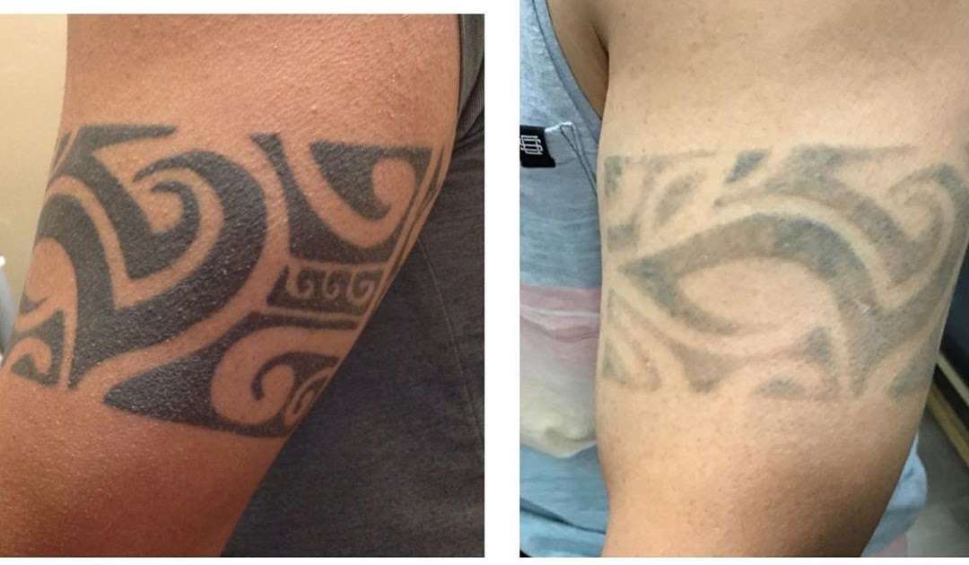 Free Tattoo Removal San Jose