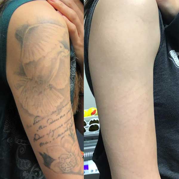 Full and Half Sleeve Tattoo Removal