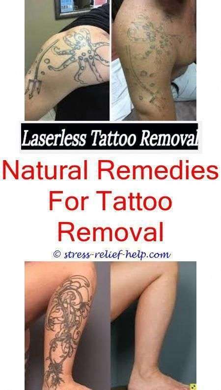 Future of tattoo removal.Can you get a tattoo removed while your ...