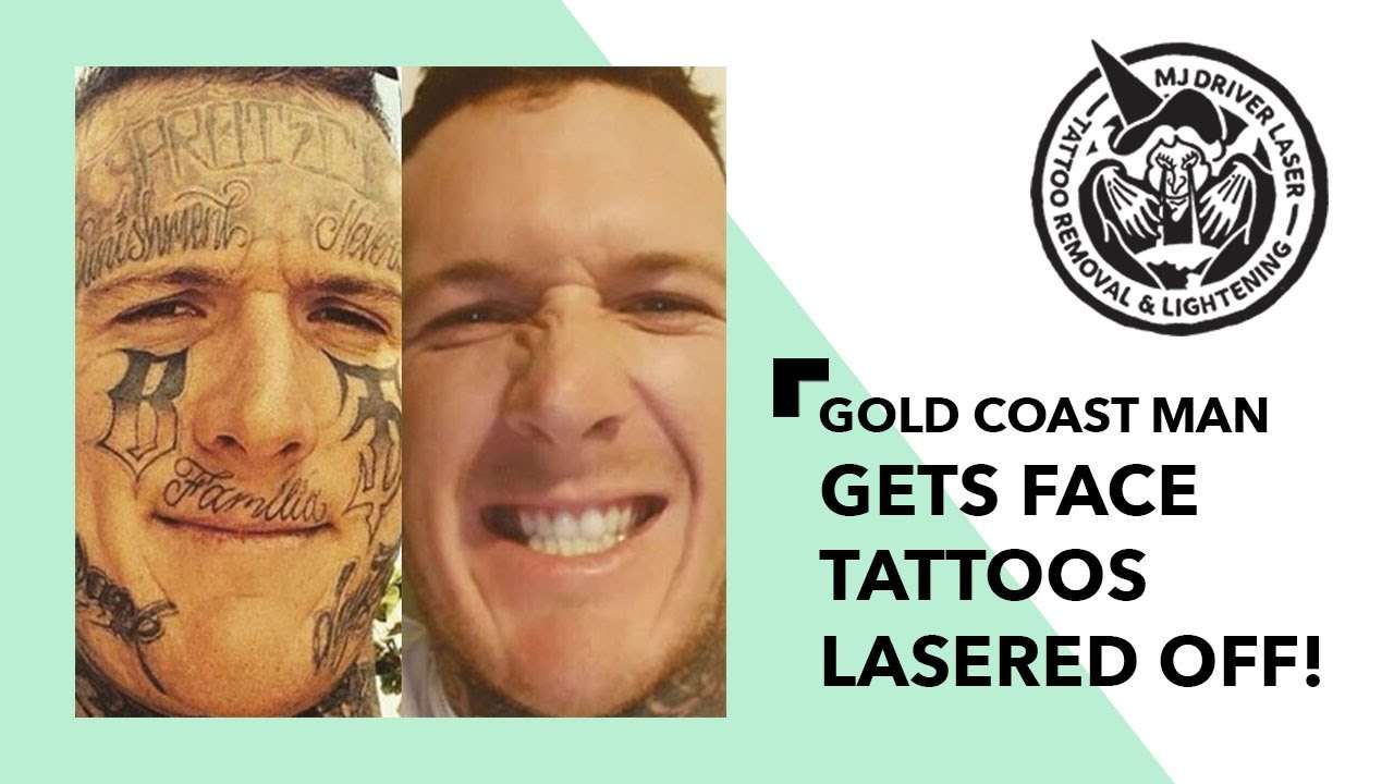 Gold Coast man with face tattoos gets them lasered off!