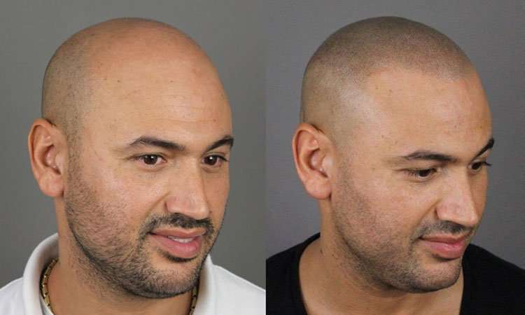 Hair Tattoo: What Is Scalp Micropigmentation? Cost, Before &  After Pics