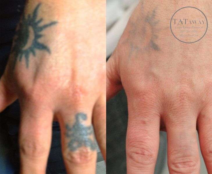 Hand tattoo removal before and after