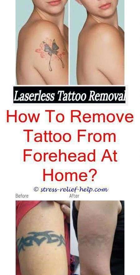 How Bad Does It Hurt To Get A Tattoo Removed