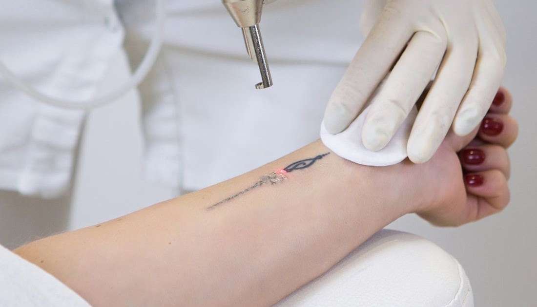 How Bad Does Tattoo Removal Hurt Reddit