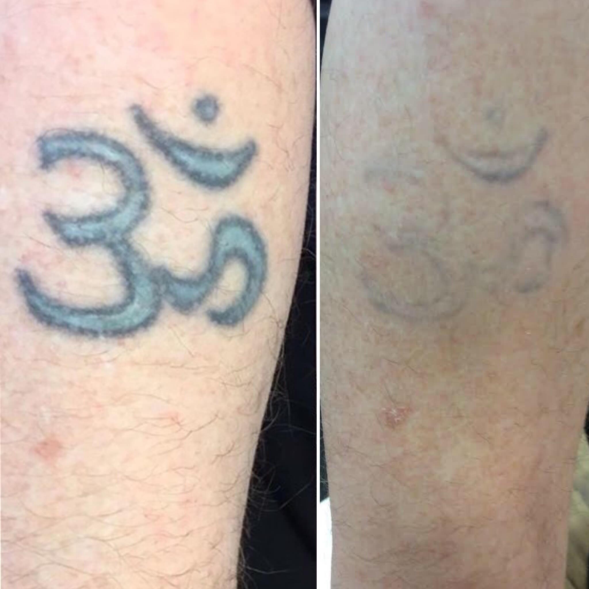 How can I speed up the Tattoo Removal Process ?  LaserYou PicoSure ...