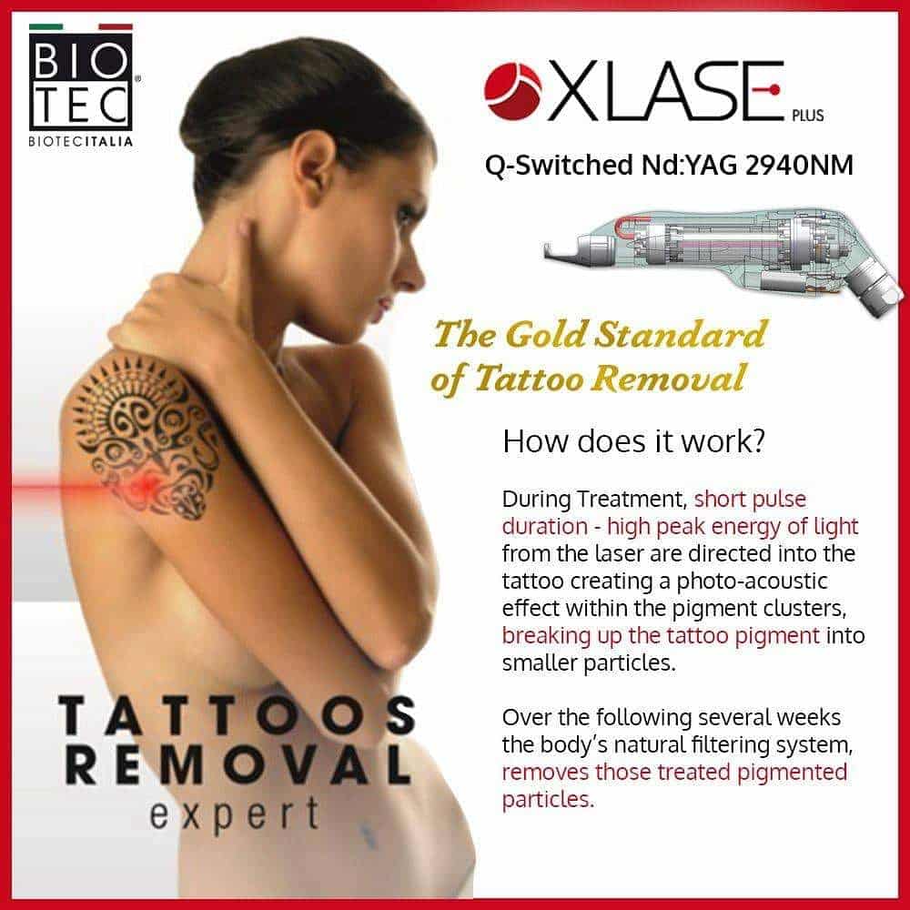 How Does A Laser Remove A Tattoo : How Much Does Laser Tattoo Removal ...