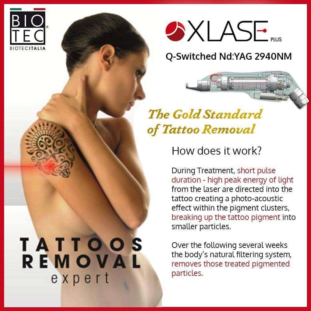 How Does A Laser Remove A Tattoo : How Much Does Laser ...