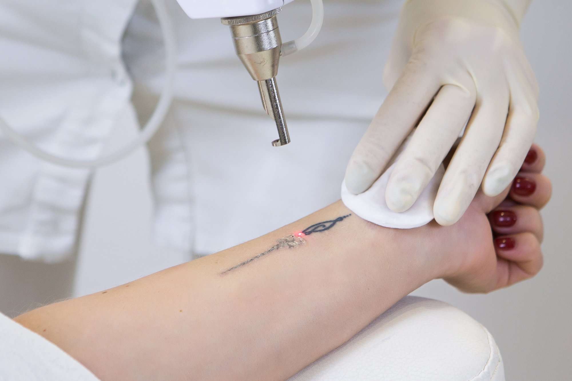 How Does Laser Tattoo Removal Work? 7 Facts You Need to Know