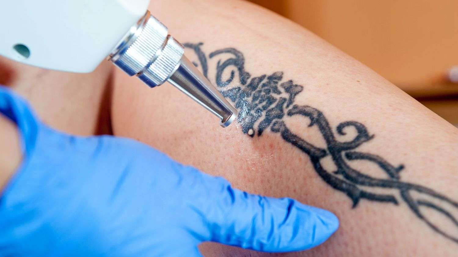 How Does Tattoo Removal Work?