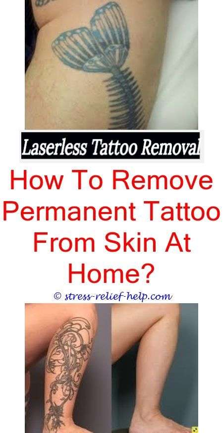 How does tattoo removal work.Will tattoo removal get ...