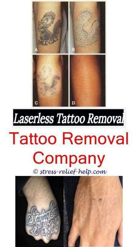 How hard to remove a tattoo.Finger tattoo removal cost ...