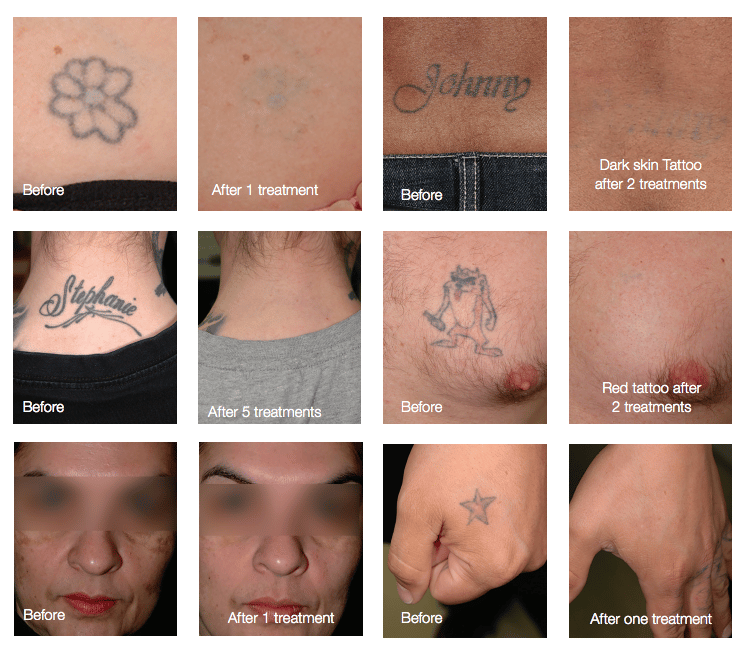 How Long After Laser Tattoo Removal Will Tattoo Fade