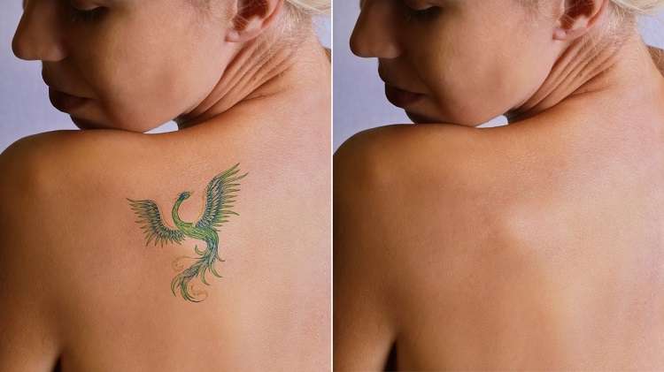 How Long After Laser Tattoo Removal Will the Tattoo ...