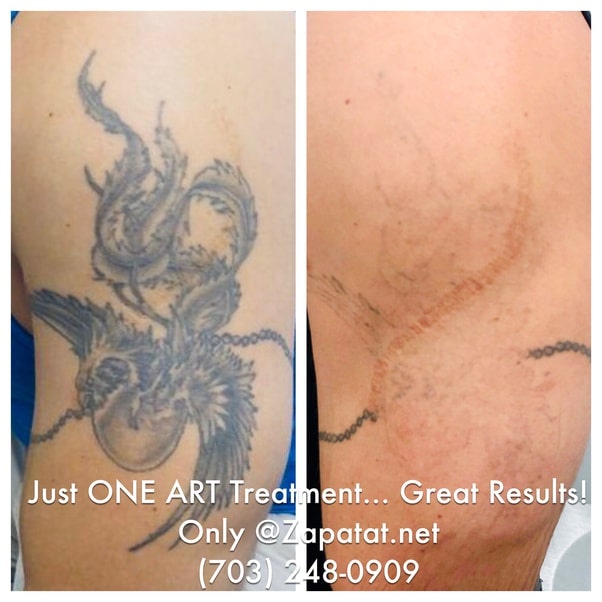 How long can a tattoo continue to fade after a laser removal session ...