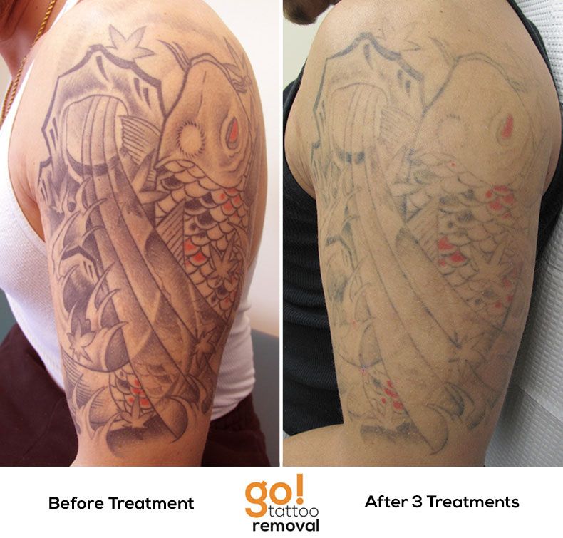 How Long Does It Take For A Tattoo To Fade After Laser Treatment