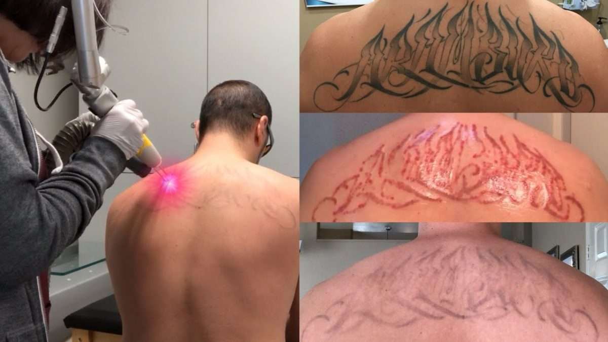 How long does it take laser tattoo removal to heal before I can fight?