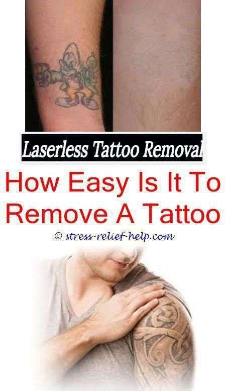 How Long Does It Take To Heal After Tattoo Removal
